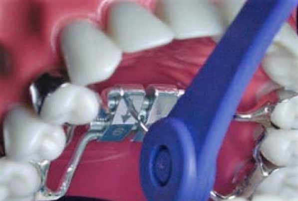 Rapid Palatal Expander (RPE) showing the adjustment key used to widen the upper jaw at Martinez Orthodontics in Kendall Miami.