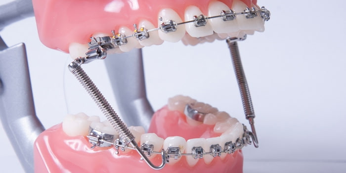Forsus Fatigue Resistant Device used for overbite correction and lower jaw growth guidance at Martinez Orthodontics in Miami.