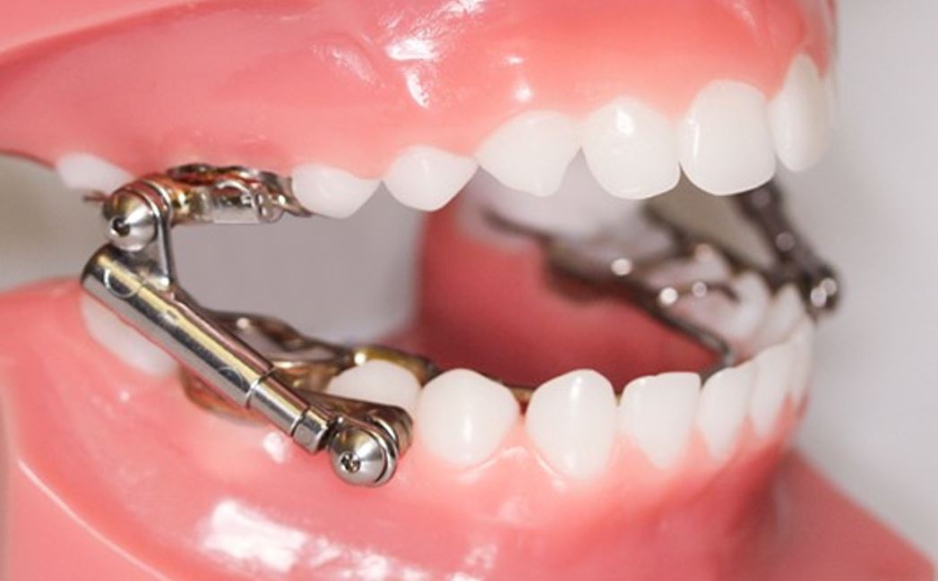 Herbst appliance used for dentofacial orthopedics and jaw growth guidance at Martinez Orthodontics in Miami and Kendall.