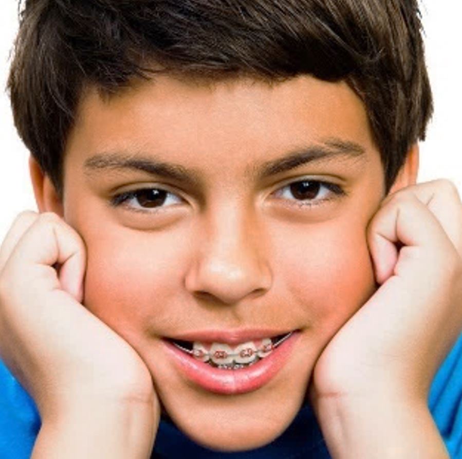 Teenager with braces completing Phase Two orthodontic alignment at Martinez Orthodontics in Miami