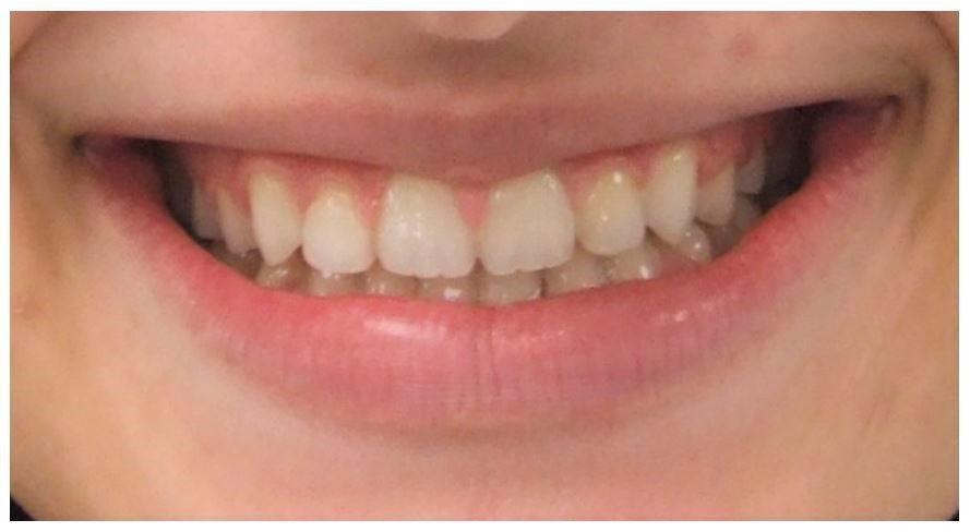 Camouflage orthodontic treatment of Adult Class III malocclusion