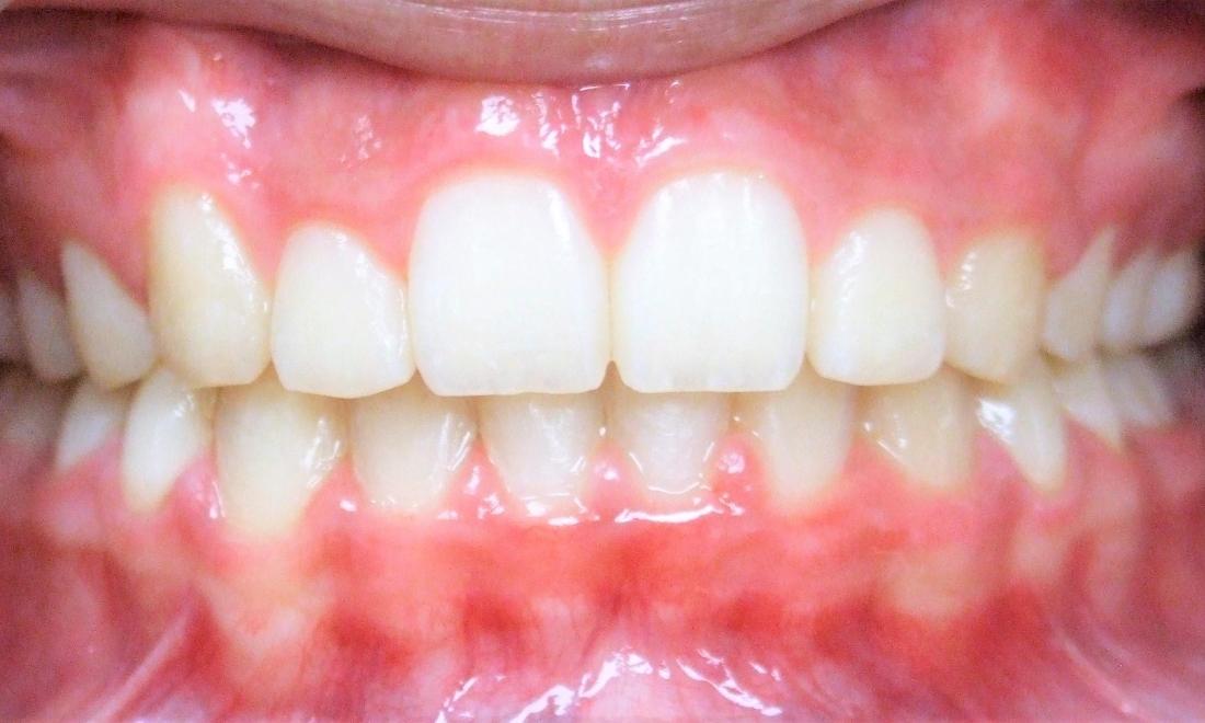 Correction of overbite with braces