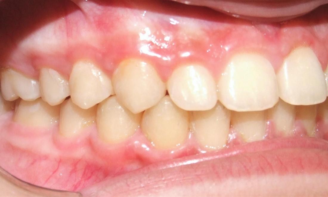 Improved inclination of anterior front teeth after braces