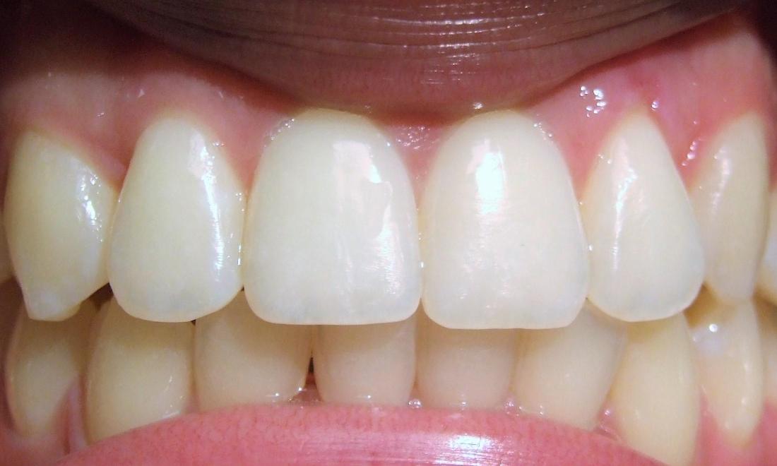 Improved smile and dental aesthetic after adult traditional braces