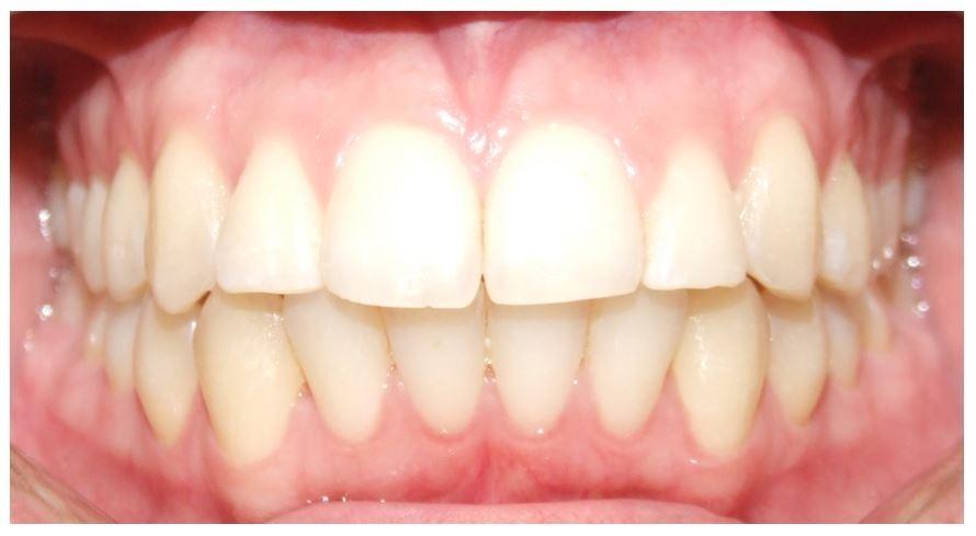 Adult orthodontic treatment to correct blocked out canines