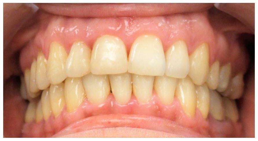 Dental protrusion corrected with adult braces