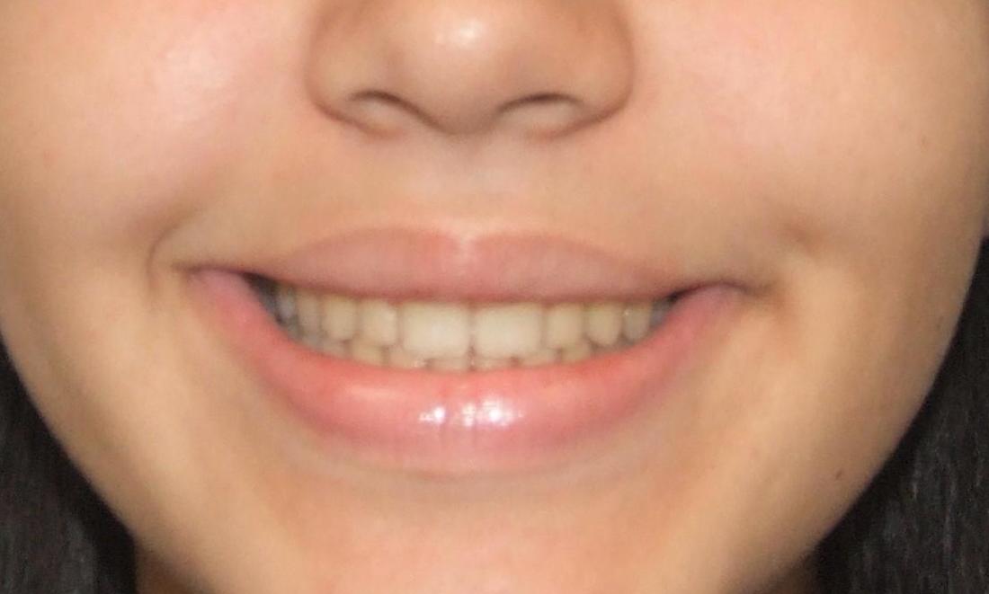Broad Smile after expanding the upper jaw
