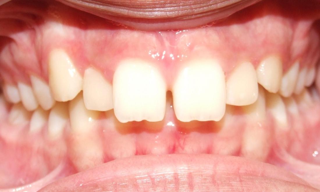 Impinging Overbite