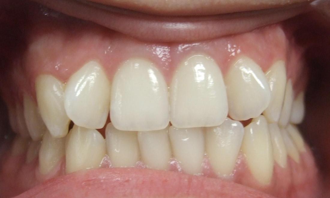 Moderate dental crowding on adult female