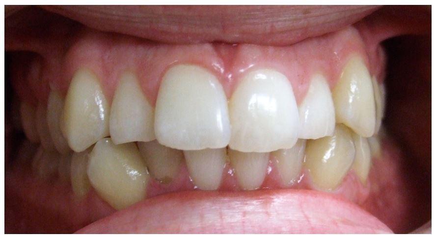 Adult patient with blocked out lower canines