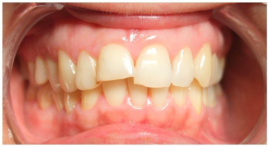 Protruding front teeth with traumatic fracture