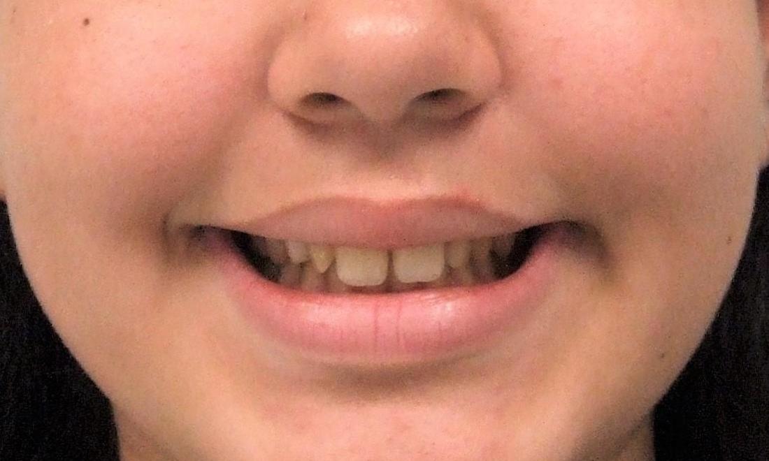 Narrow Smile due to Narrow upper jaw