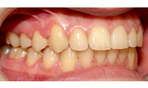 Corrected bite intraoral view after 24-month Herbst appliance treatment by Miami orthodontist.