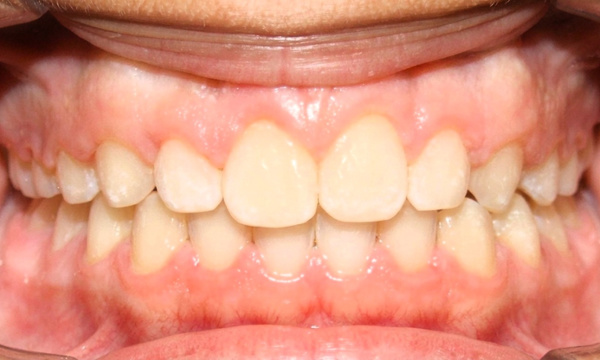 Final orthodontic result showing complete diastema closure and overjet correction by Dr. Martinez in Kendall.