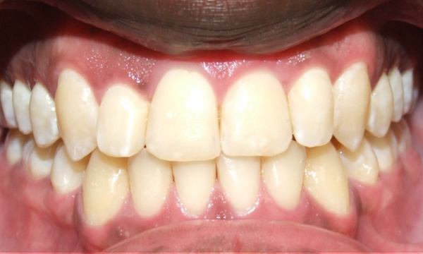 Post-extraction result showing complete resolution of lower crowding and Class III correction by Dr. Jesus Martinez in Kendall.