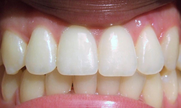 Perfectly aligned teeth and improved smile aesthetic following specialist adult braces in Kendall.