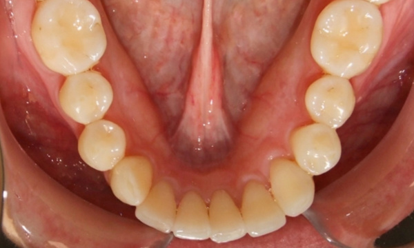 Beautifully aligned adult smile after 18 months of traditional braces in The Crossings. 