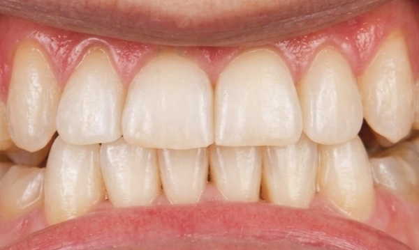 Adult expansion and braces results showing corrected arch width and aligned midlines in Kendall.