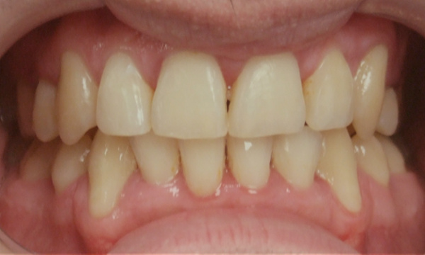 Frontal intraoral view of the completed case post-treatment, showcasing a beautifully aligned smile, corrected bite, and ideal tooth positioning following comprehensive orthodontic at martinez orthodontics in Miami.