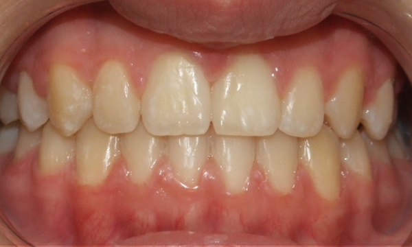  Final smile after 24 months of comprehensive orthodontic treatment with RPE and traditional braces by Dr. Martinez in Kendall.