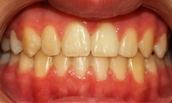  Final smile after 24 months of comprehensive orthodontic treatment with RPE and traditional braces by Dr. Martinez in Kendall.