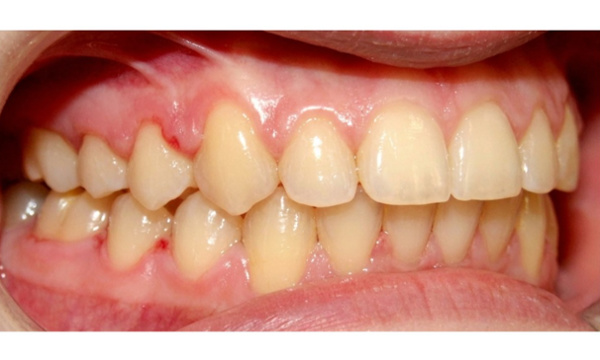 Corrected bite intraoral view after 24-month Herbst appliance treatment by Miami orthodontist.