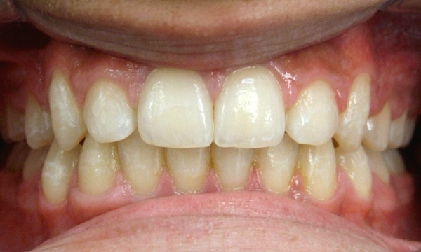 Expanded palate and aligned smile after 24-month non-extraction treatment by Miami orthodontist.