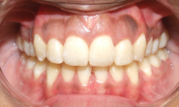 Final result of complex adult orthodontics showing closed open bite and corrected crossbite by Dr. Martinez in Kendall.