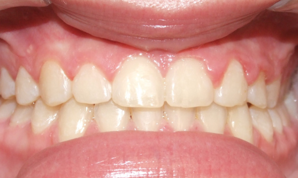 Stable smile with closed diastemas and corrected bite after braces and post-orthodontic frenectomy in Kendall.