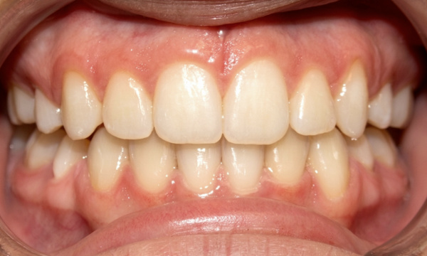 Successful alignment and crowding resolution following metal braces and premolar extractions in Kendall.