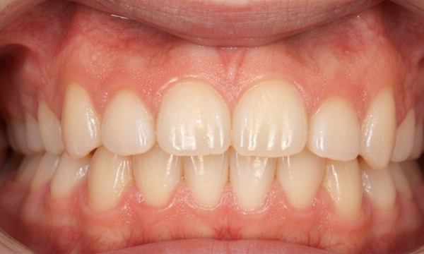 Corrected deep bite and improved smile aesthetics after 30 months of comprehensive orthodontics in Kendall.