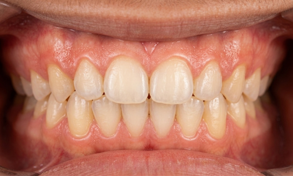Close-up of ideal overbite and overjet alignment following specialized orthodontic care in Kendall.