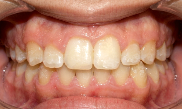 Broad, aligned smile with closed spaces and a corrected bite after 30 months of palatal expansion and metal braces treatment in Kendall.