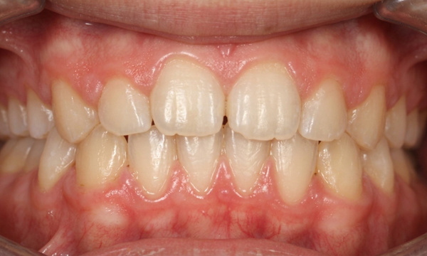 Corrected jaw alignment and closed diastemas following 30 months of Herbst and braces treatment in Kendall.