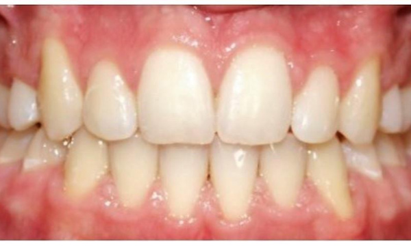 Perfectly aligned teeth and corrected bite function following braces treatment at Martinez Orthodontics.