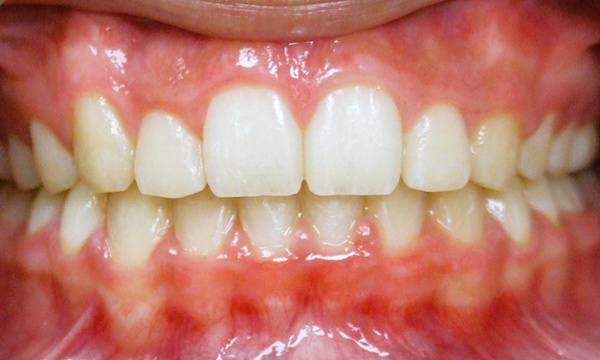 Balanced smile and corrected overbite following orthodontic treatment at Martinez Orthodontics.