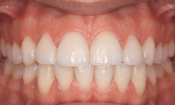 Successfully aligned teeth and a healthy smile after orthodontic treatment. 