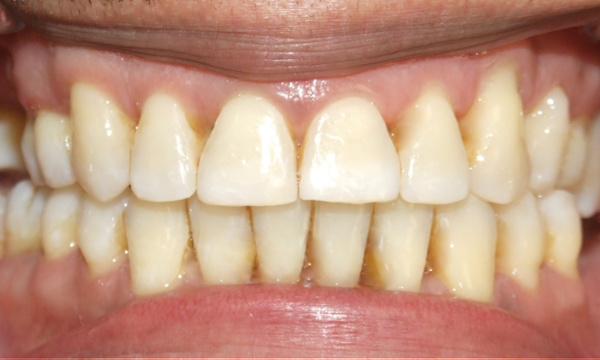 Final stable and functional bite achieved by Kendall orthodontist Dr. Martinez, structurally optimized for restorative dental implants.