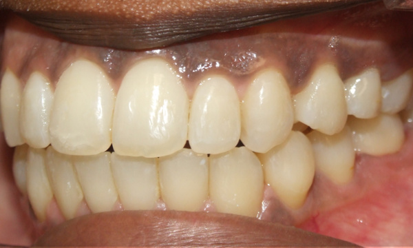 Clinical close-up showing the successful non-surgical closure of the open bite and aligned teeth.