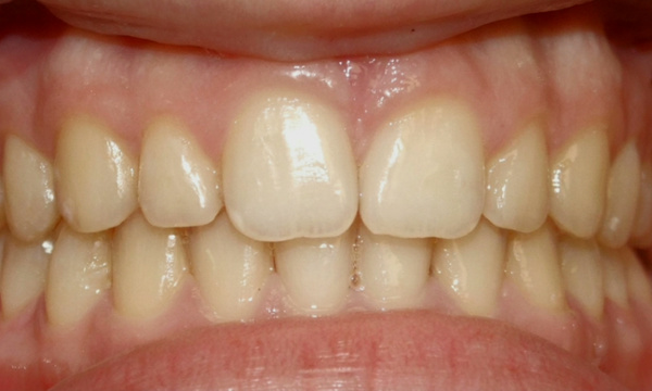 Widened maxillary arch and aligned teeth following palatal expander and braces treatment.