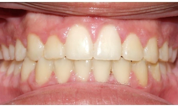 Corrected bite, expanded palate, and aligned smile after 24 months of metal braces treatment in Kendall