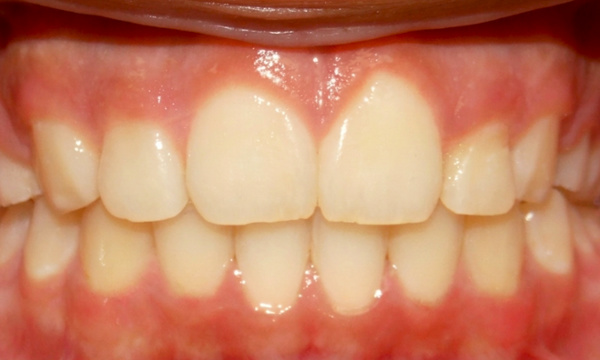 Beautifully aligned preteen smile with corrected overjet and safely retracted front teeth after metal braces by Kendall Orthodontist.