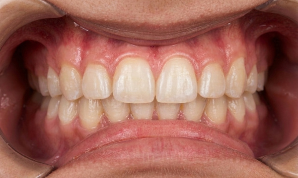 Broad, aligned smile and corrected bite after 30 months of palatal expansion and metal braces treatment in Kendall.