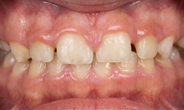 Corrected anterior crossbite and expanded arch after Phase I early intervention with an expander and partial braces by Kendall Orthodontist.