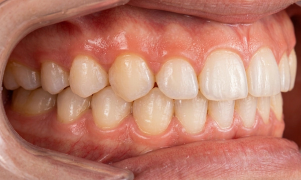 Corrected tooth inclination and closed gaps after braces and habit-control treatment in Kendall
