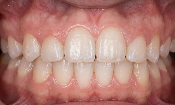 Corrected alignment and straight smile after traditional braces for a teen patient in Kendall.