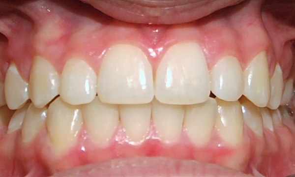 Successfully aligned canine and corrected bite after 24 months of coordinated surgical and orthodontic treatment in Kendall.