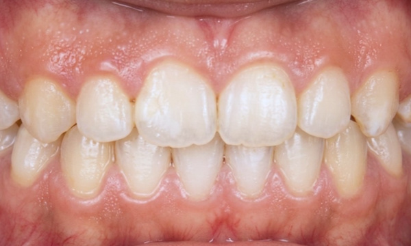 Straight teeth and a comfortable bite after 24 months of braces in Kendall.