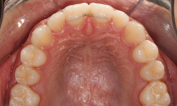Upper dental arch photo showing beautifully aligned teeth with all gaps completely closed and secured with a fixed retainer.