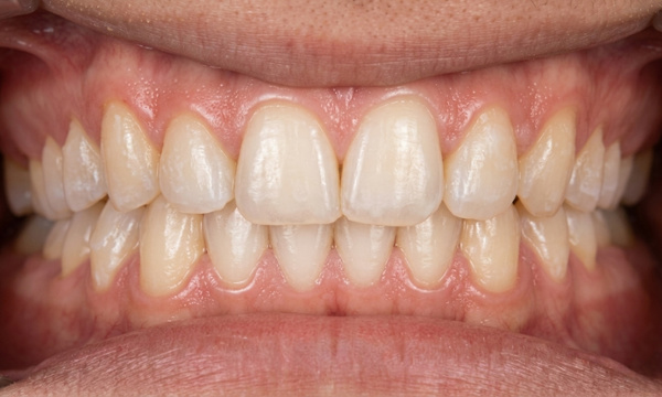 Beautifully aligned teen smile with corrected jaw position and restored front tooth after braces and Herbst treatment by Kendall Orthodontist.